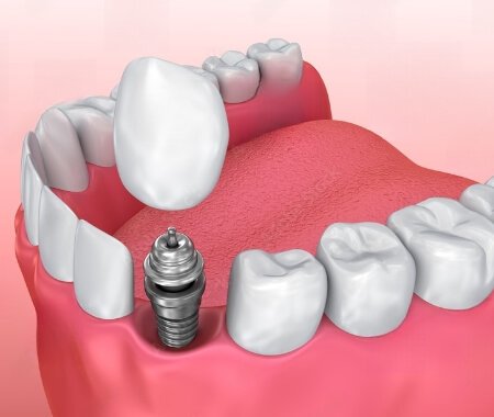 Dental implant