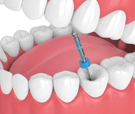 Dental implant